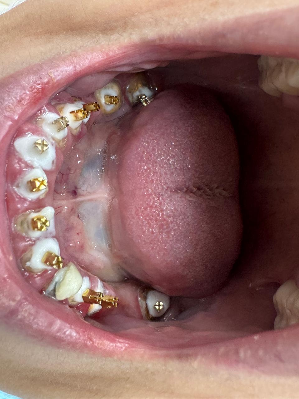 Full mouth rehabilitation: Severely attrited teeth restored with multiple root pins and zirconium crowns treatment